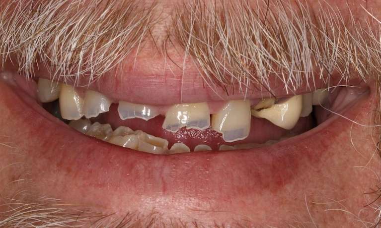 Close up of older mans mouth with mustace before implant dentures, nashville tn