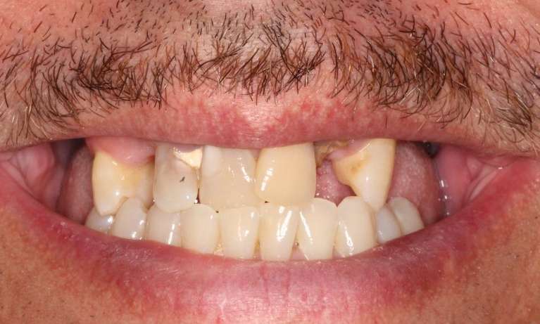 Mans mouth with a mustache before implant dentures, nashville tn