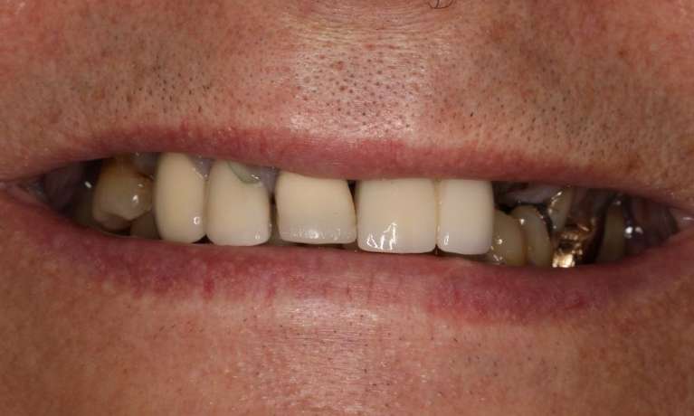 Mouth before implant dentures, nashville tn