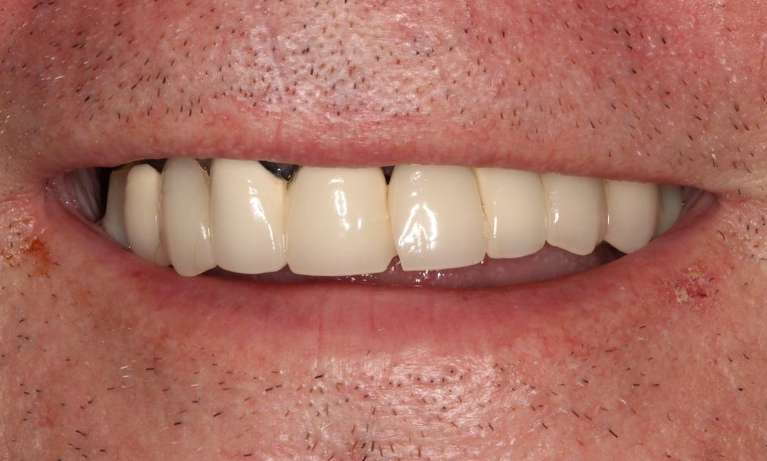 Mans mouth before implant dentures, nashville tn