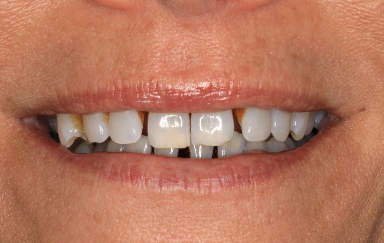 Mouth before implant-supported dentures, nashville tn