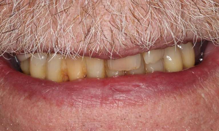 Close of older mans teeth with a white mustache before implant-supported dentures, Nashville tn