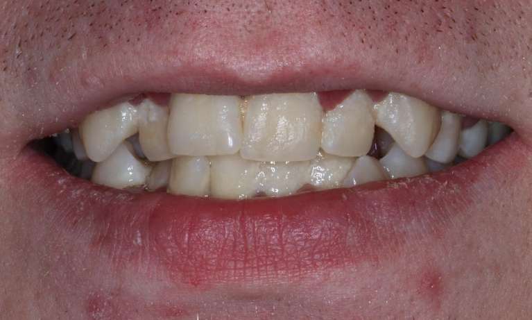 Invisalign-LANAP-Before-Image