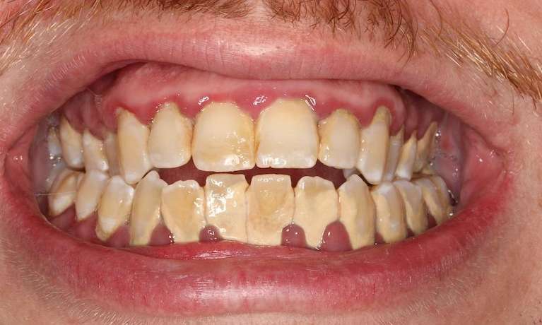 LANAP-Laser-Periodontal-Treatment-Before-Image