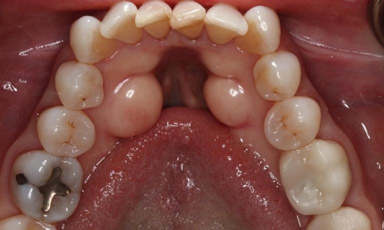 Lingual-Tori-Removal-Before-Image