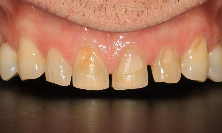 Smile-Makeover-Crowns-Sleep-Apnea-Treatment-Before-Image
