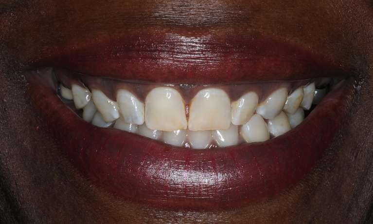 Smile-Makeover-Before-Image
