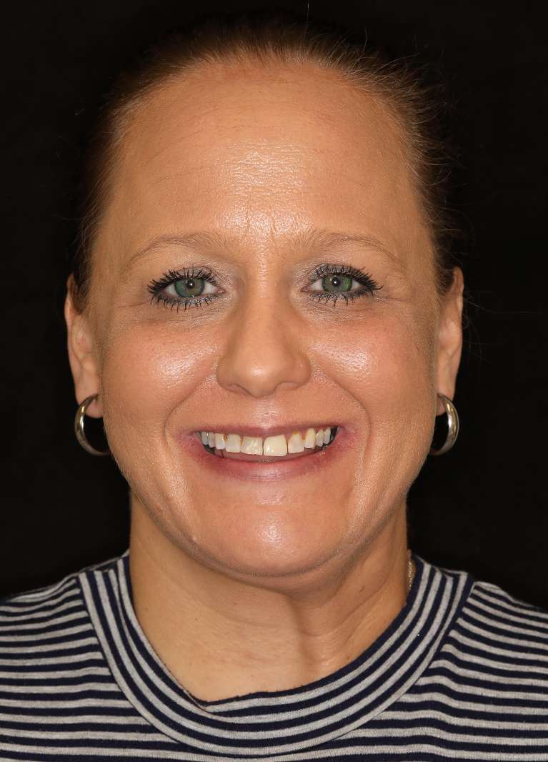 Before a smile makeover picture of a woman smiling in nashville, tn 