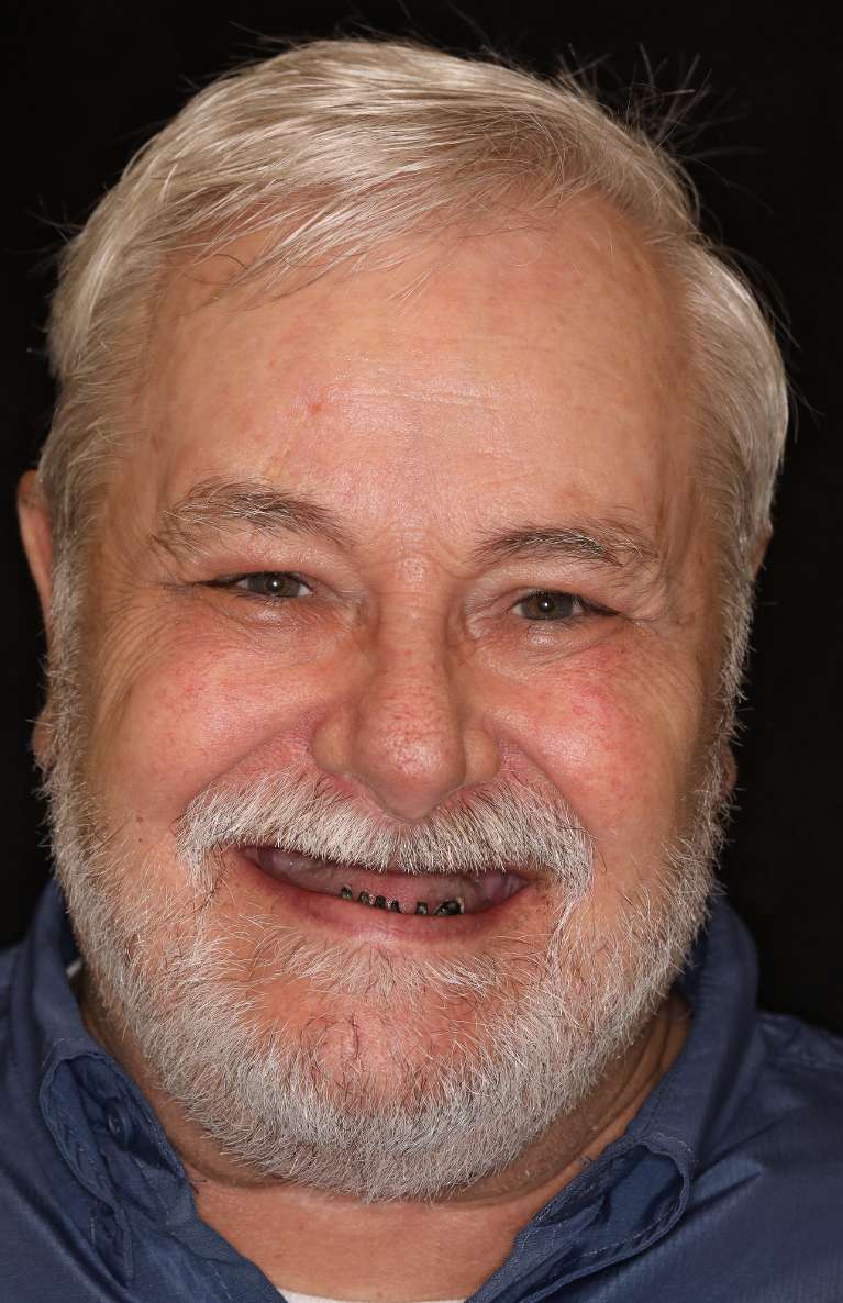 Before picture of a man before a Top Denture and Bottom Implant Snap In Denture, nashville tn