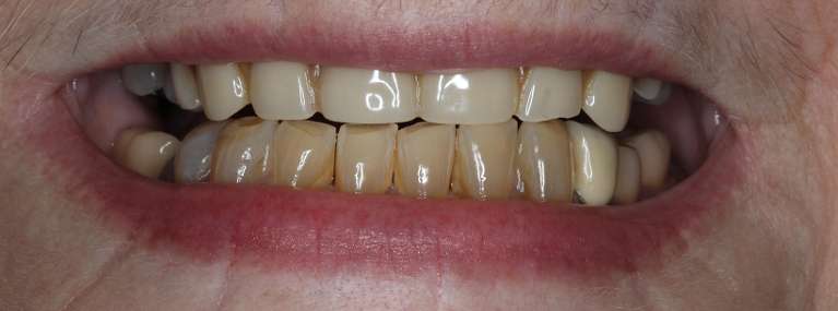 Close up of elderly woman smiling before all-on-x implant dentures, nashville tn