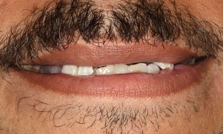 Close up of man smiling before all-on-x implant dentures, nashville tn