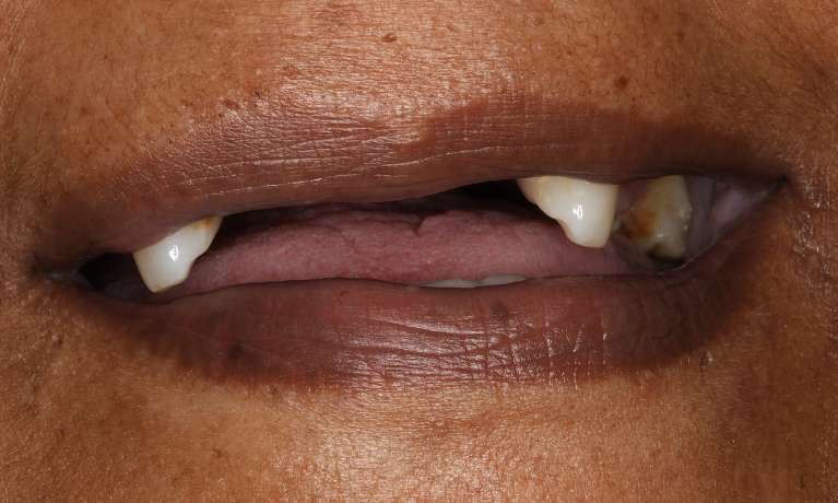 Close up view of woman smiling before all-on-x implant dentures, nashville tn