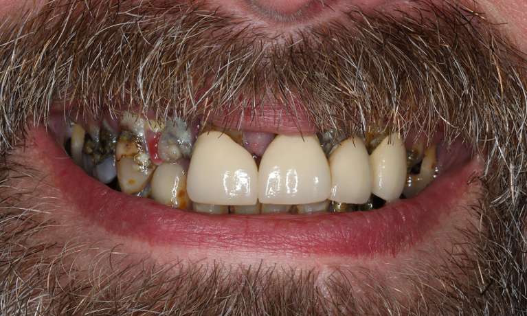 Close up view of bald man smiling before all-on-x implant dentures, nashville tn