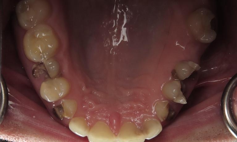 Overhead view of mouth before complete smile makeover, nashville tn