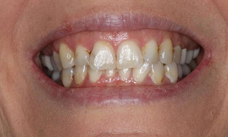 Close up of womans smiling before cosmetic crowns, brentwood tn