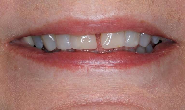 Close up of an older woman before CEREC cosmetic crowns, brentwood tn