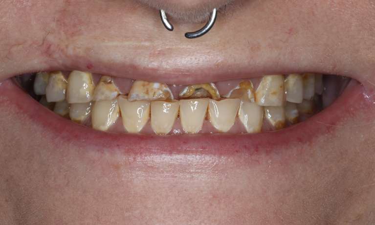Close up view of before full mouth smile makeover, nashville tn