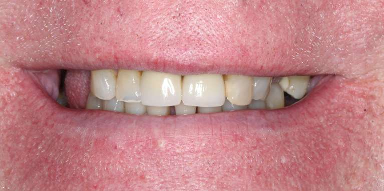 Close up of man smiling before full smile makeover, nashville tn