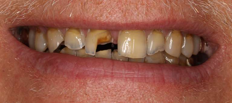 Close up view of older man smiling before a smile makeover, nashville tn