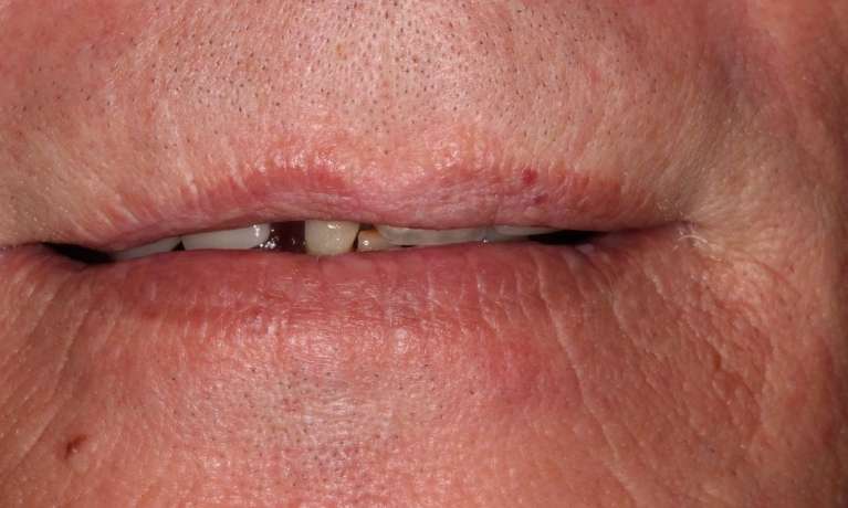 Mouth before Upper and Lower Implant-Supported Dentures, nashville tn
