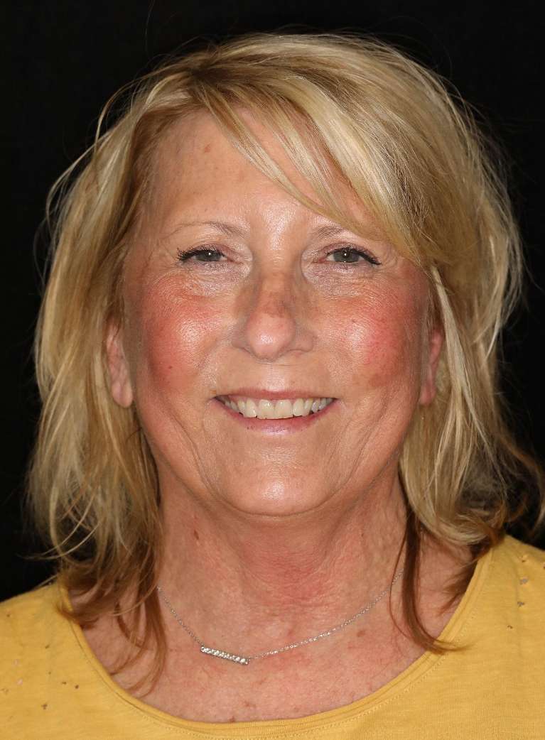 Potrait layout of blonde woman before cosmetic crowns, brentwood tn