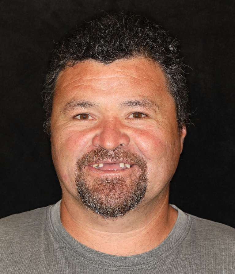 Nashville implant supported dentures- Before Photo