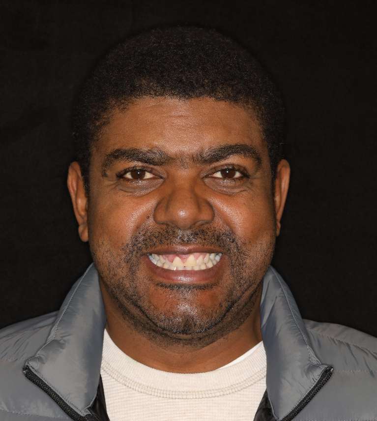 Brentwood, TN dental crowns- Before Photo