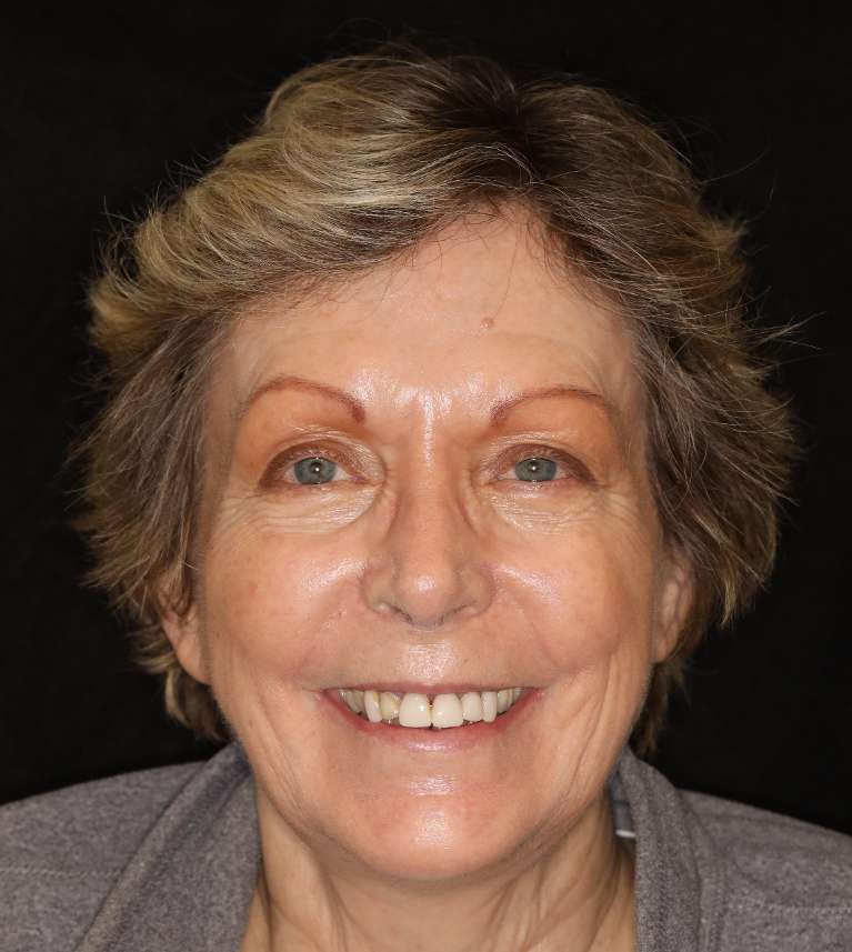 Brentwood CEREC Crowns- Before Photo